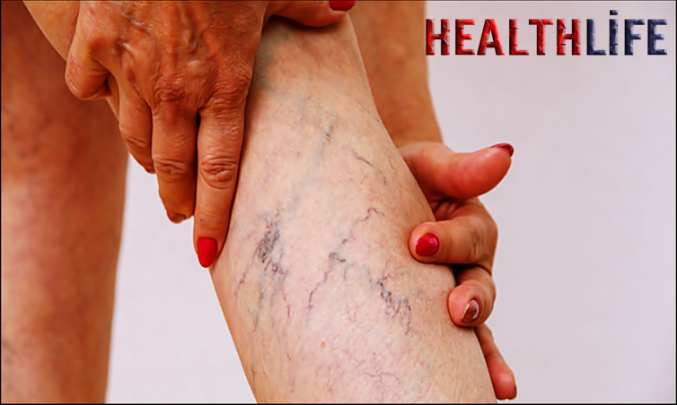 What Is The Best Treatment For Varicose Veins