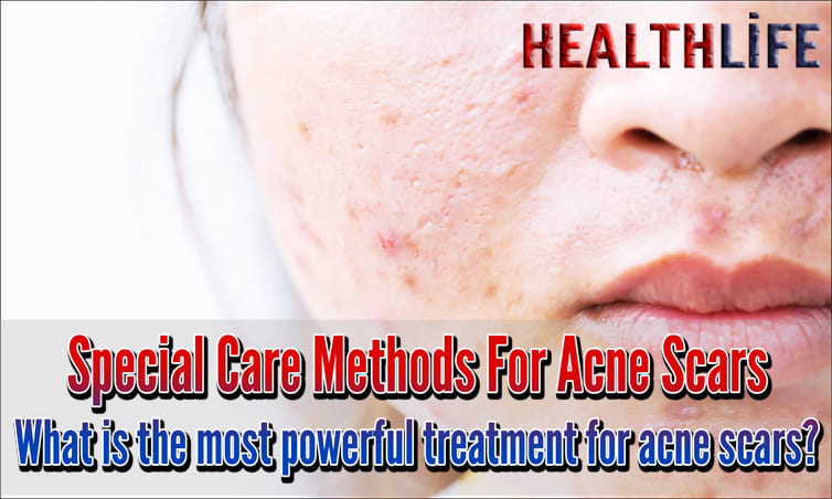 Special Care Methods For Acne Scars