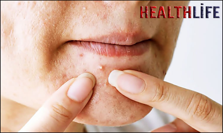 How To Get Rid Of Acne On The Face