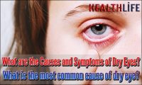 What Are The Causes And Symptoms Of Dry Eyes