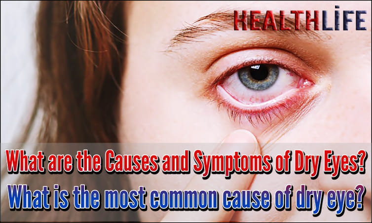 What Are The Causes And Symptoms Of Dry Eyes