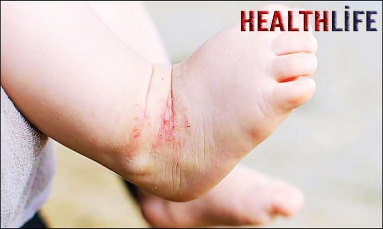 What Are the Major Causes Of Eczema