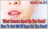 What Causes Acne On The Face