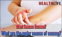 What Causes Eczema