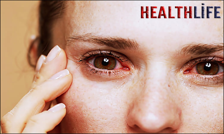 What Is The Most Common Cause Of Dry Eye