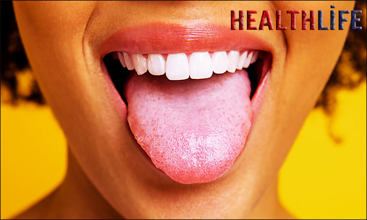 What Vitamin Deficiency Causes Tongue Color