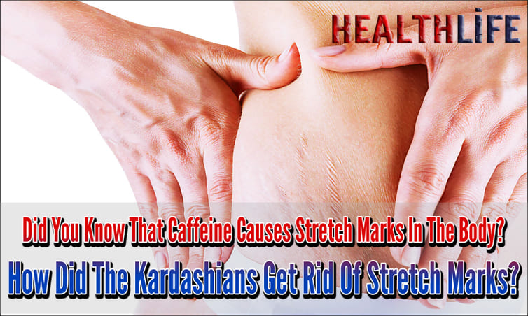 Did You Know That Caffeine Causes Stretch Marks In The Body