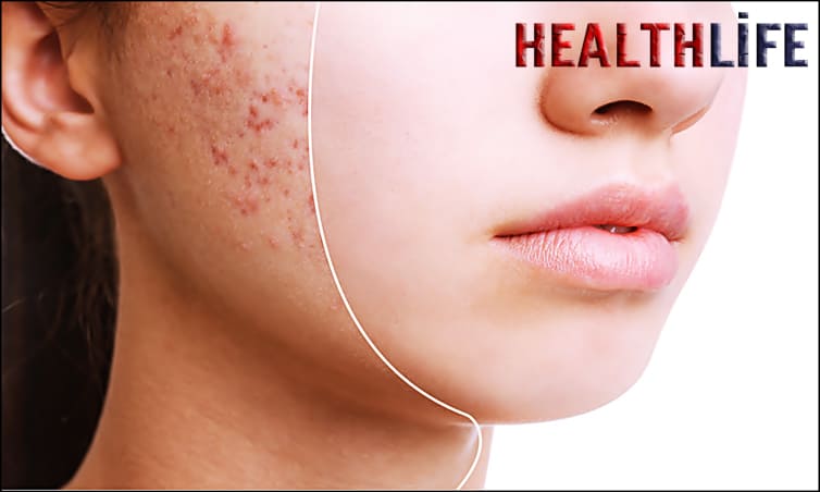 Do Acne Scars Ever Go Away