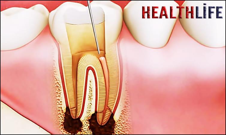 How Do You Know If You Have A Tooth Root Infection