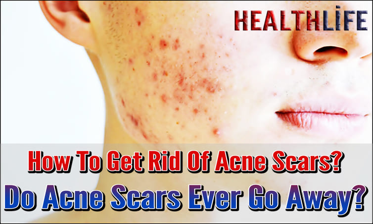 How To Get Rid Of Acne Scars