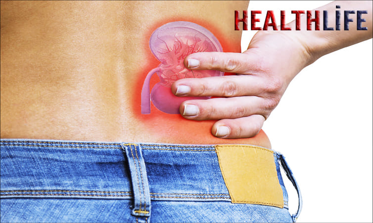 How To Pass Kidney Stones Quickly