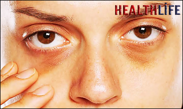 How To Permanently Remove Dark Circles