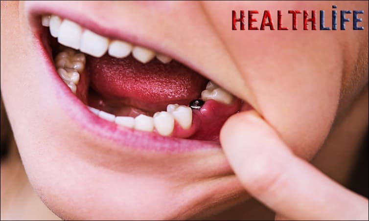Is It Common To Have A Missing Tooth