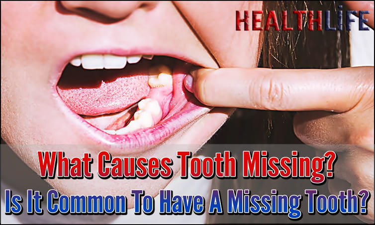 What Causes Tooth Missing