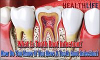 What Is Tooth Root Infection