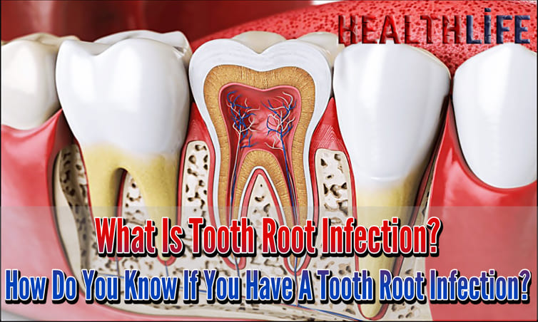 What Is Tooth Root Infection