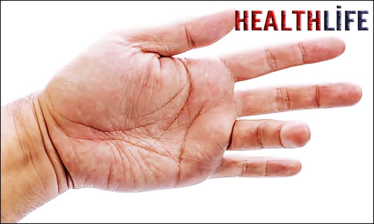 Which Vitamin Deficiency Causes Trigger Finger