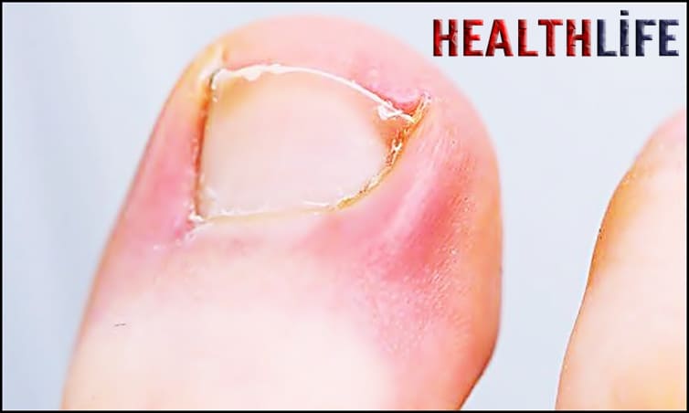 How Can I Avoid Getting Ingrowns On My Toe Nails