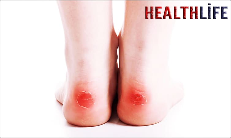 How Do I Stop My Feet From Getting Blisters