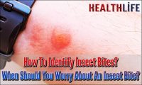 How To Identify Insect Bites