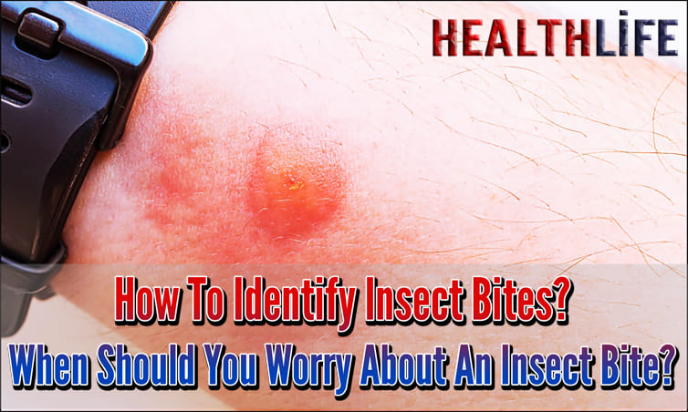 How To Identify Insect Bites