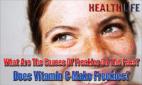 What Are The Causes Of Freckles On The Face