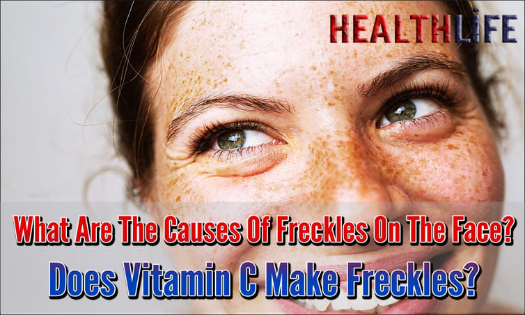 What Are The Causes Of Freckles On The Face