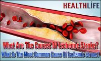 What Are The Causes Of Ischemic Stroke
