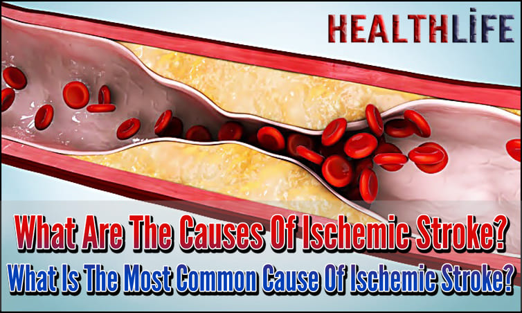 What Are The Causes Of Ischemic Stroke