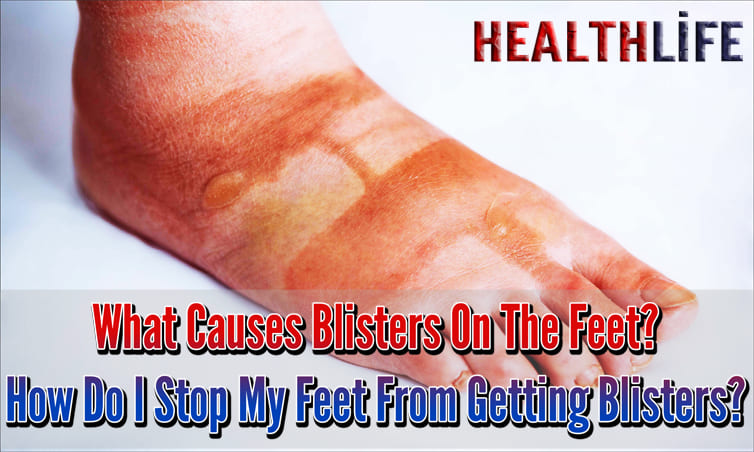 What Causes Blisters On The Feet