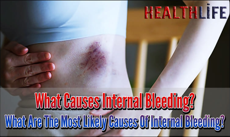 What Causes Internal Bleeding