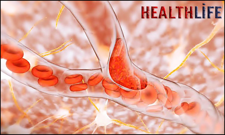 What Is The Most Common Cause Of Ischemic Stroke