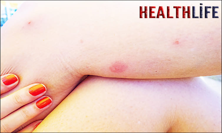 When Should You Worry About An Insect Bite