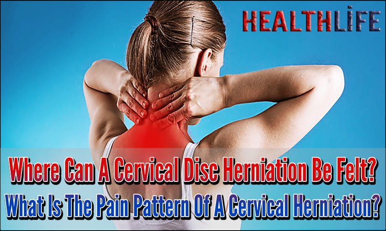 Where Can A Cervical Disc Herniation Be Felt