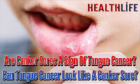 Are Canker Sores A Sign Of Tongue Cancer