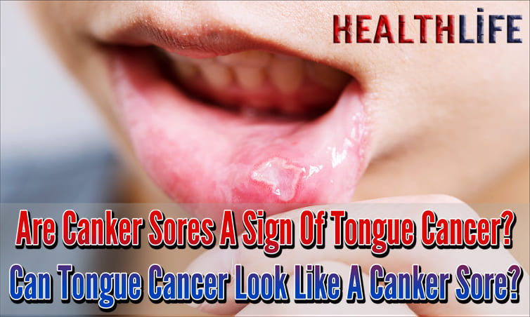 Are Canker Sores A Sign Of Tongue Cancer