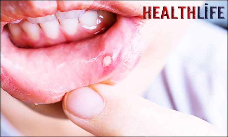 Can Tongue Cancer Look Like A Canker Sore