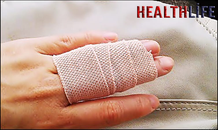 How Do You Treat A Sprained Finger Naturally