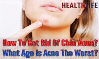 How To Get Rid Of Chin Acne