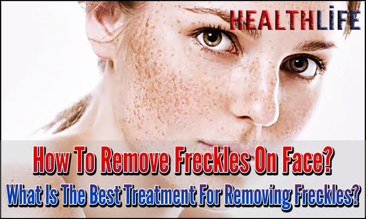 How To Remove Freckles On Face