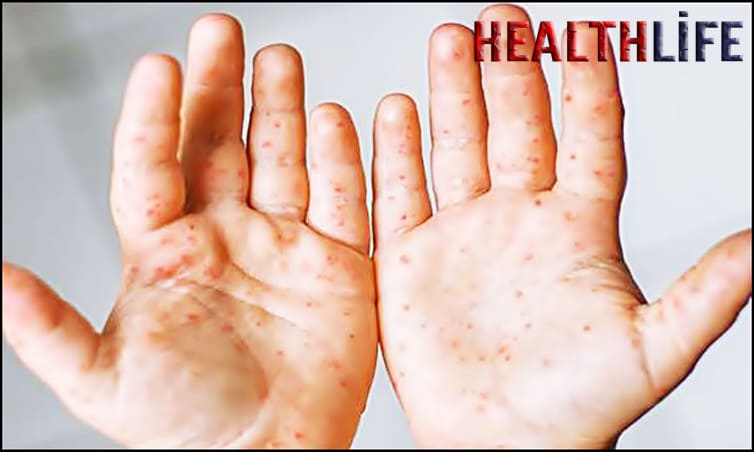 How To Treat Root Disease