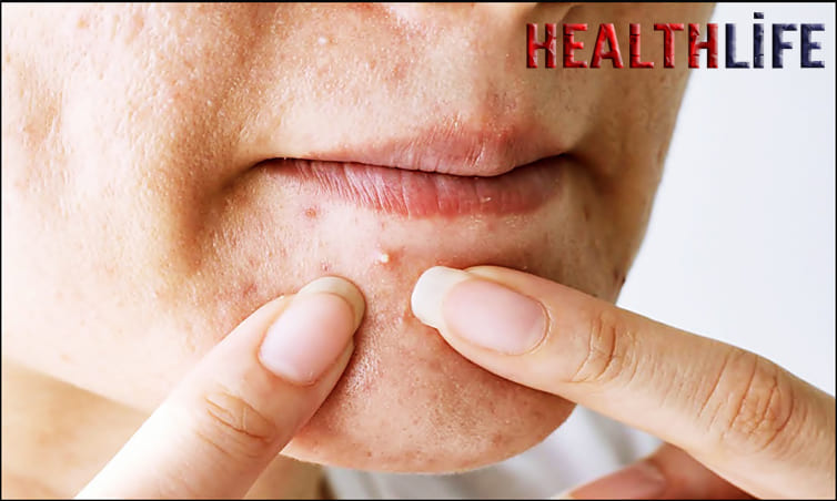 What Age Is Acne The Worst