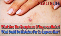 What Are The Symptoms Of Ingrown Hairs