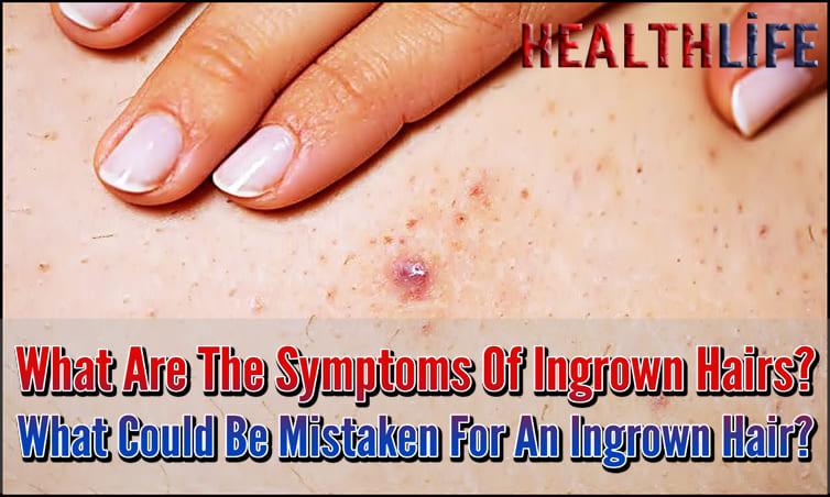 What Are The Symptoms Of Ingrown Hairs