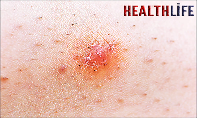 What Could Be Mistaken For An Ingrown Hair