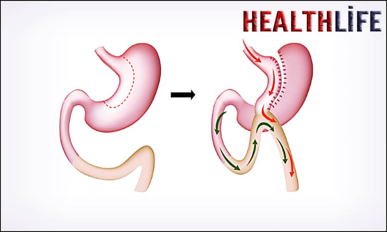 What Disqualifies You From Gastric Surgery