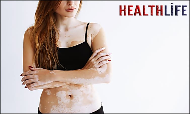 What Does A Vitiligo Look Like