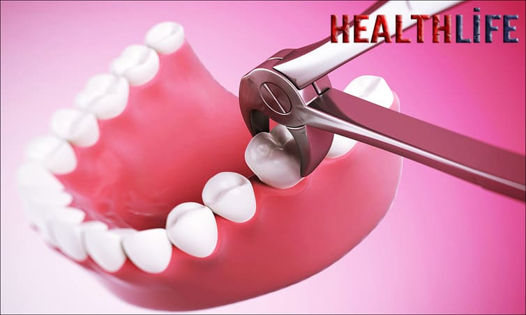 What Is The Best Thing To Do After A Tooth Extraction