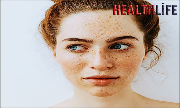 What Is The Best Treatment For Removing Freckles