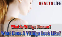What Is Vitiligo Disease